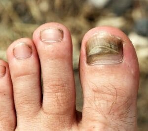 Fungal Infection on big toe