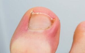 Infected Toe (A Guide To Your Dealing With Your Toe Pain)