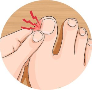 Ingrown Toenail Removal/Treatments