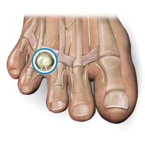 Diagram Of Mortons Neuroma