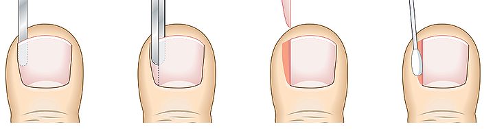 Ingrown Toe Nail Surgery - Aura Plastic Surgery