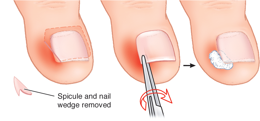 Podiatry trainer | Nail surgery 'starter kit' | Medimodels