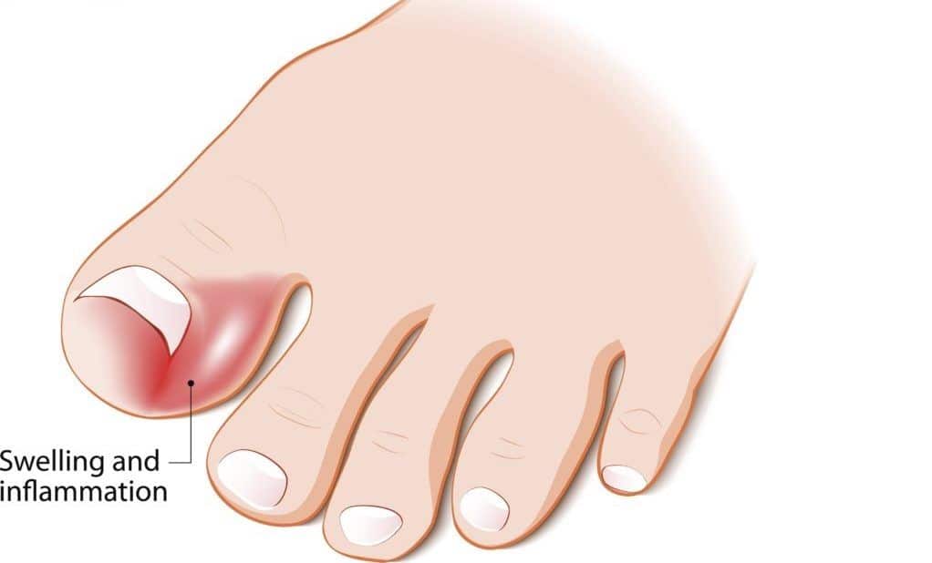 Ingrown Nail