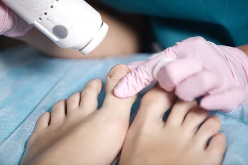 Should You Invest in Fungal Nail Laser Treatment? ModPod Podiatry