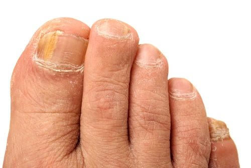 95% Effective Fungal Nail Treatment Cure - Compleet Feet