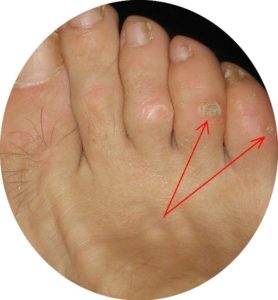 Corn in foot pain top