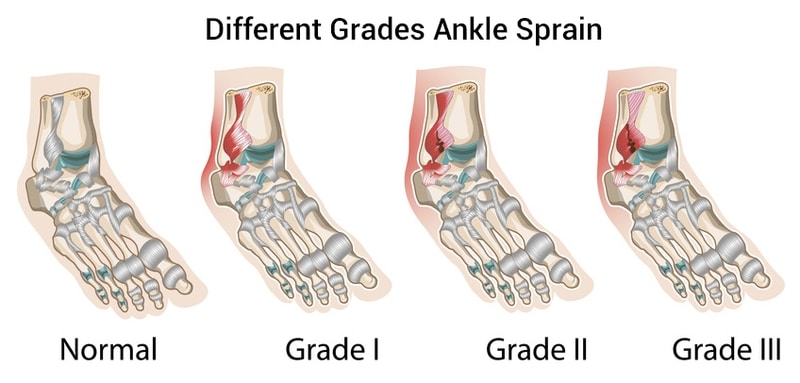 graded ankle sprain