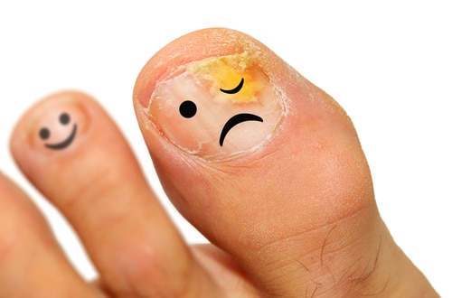 get rid of fungus, Image by ModPod Sports Podiatry