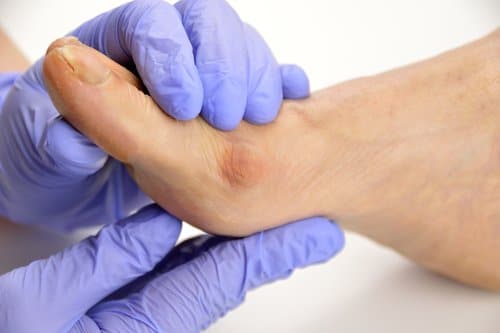 Podiatrist checking on a bunion