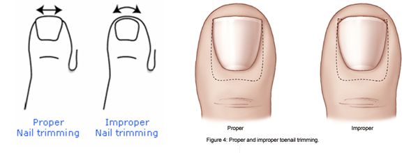 Consult Corner: Laceration through the nail bed | ASPS