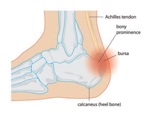 retro-calcaneal-bursa