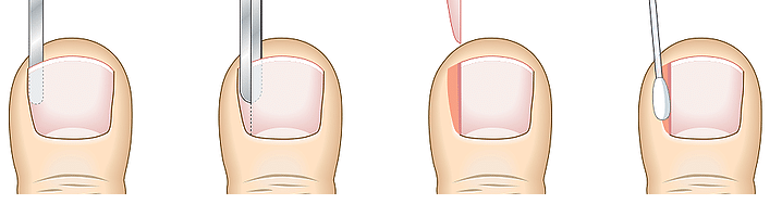 Bruising after ingrown toenail removal? : r/Ingrown_Toenails