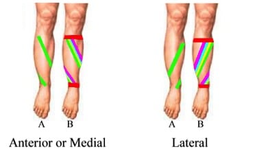 Strapping for Shin Splints