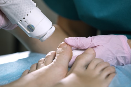 Laser Nail Fungus Removal, Image by ModPod Sports Podiatry