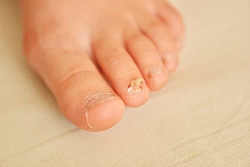 toenail Fungus Medication