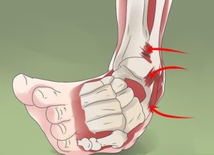 Ankle Sprain