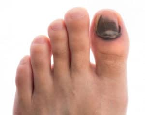 black-toenail-300x239