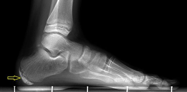 Heel pain in a child? Most likely it's Sever's disease – Growing Pains. –  Dr. Nicholas Campitelli