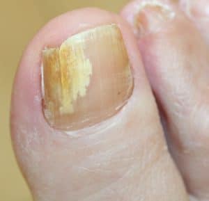 fungal nail infection