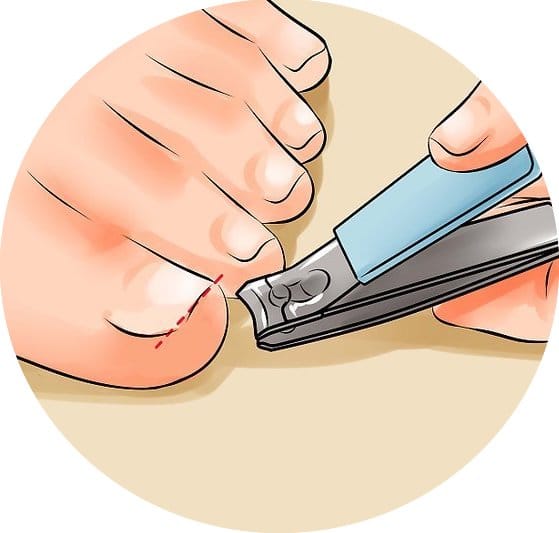 how to fix an ingrown toenail