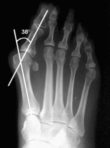 Hallux valgus angle