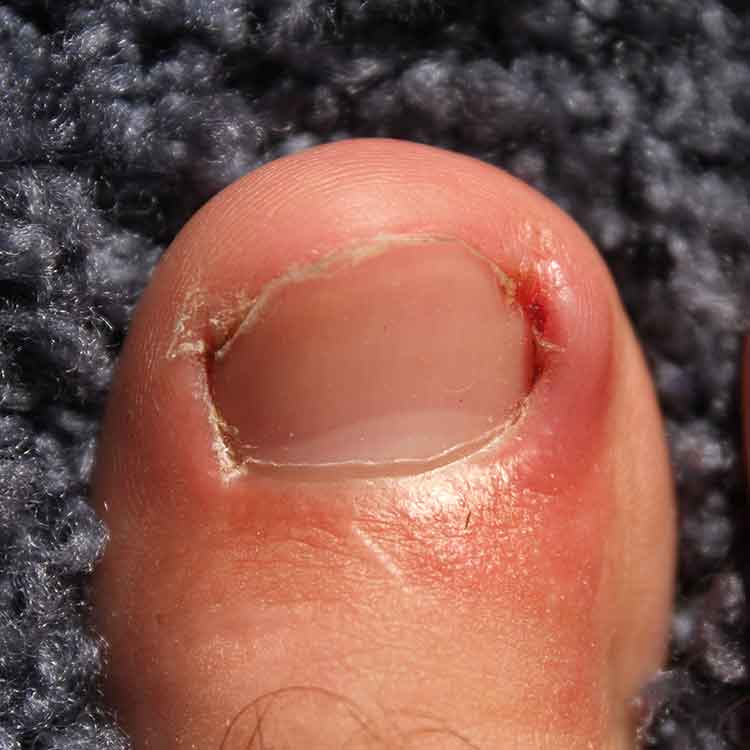 Finger Infection Looks Like it's Going to Explode : r/mildlyinteresting