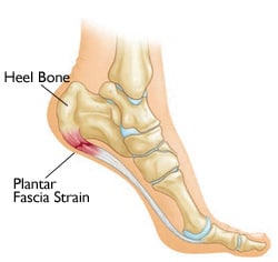 plantar-fascia-strain