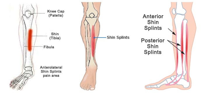 What are shin splints