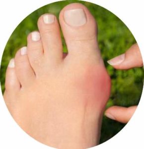 what causes a bunion