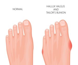 What is a bunion