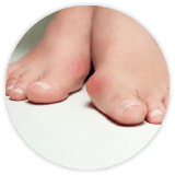 Mortons Neuroma Podiatrist Mosman