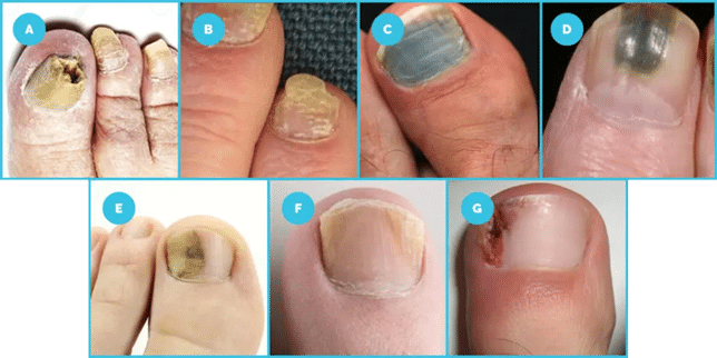 Types & Stages of Toenail Fungus | Premier Podiatry