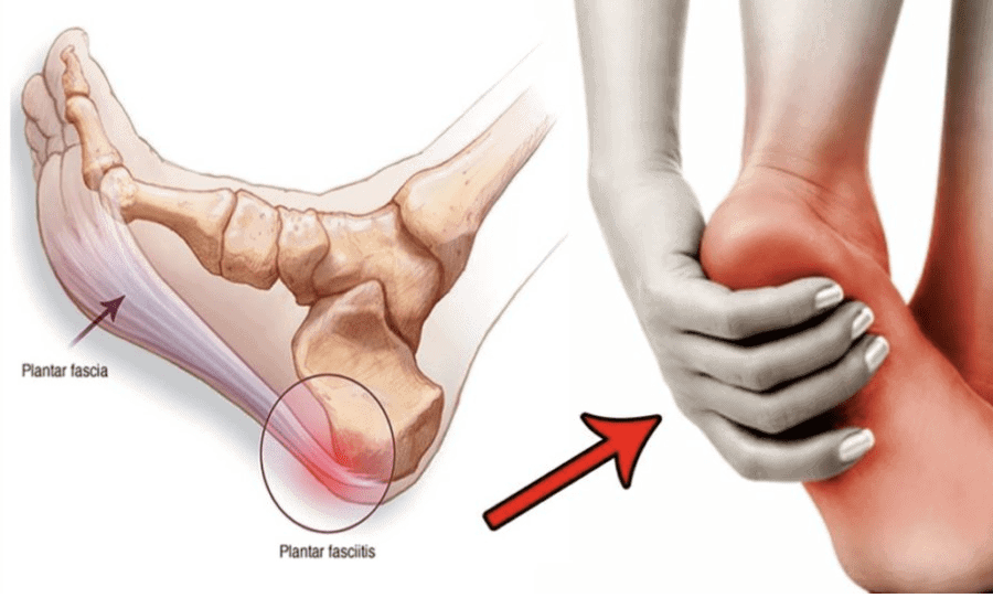 Plantar Fasciitis Treatment The Ultimate Guide - ModPod Podiatry