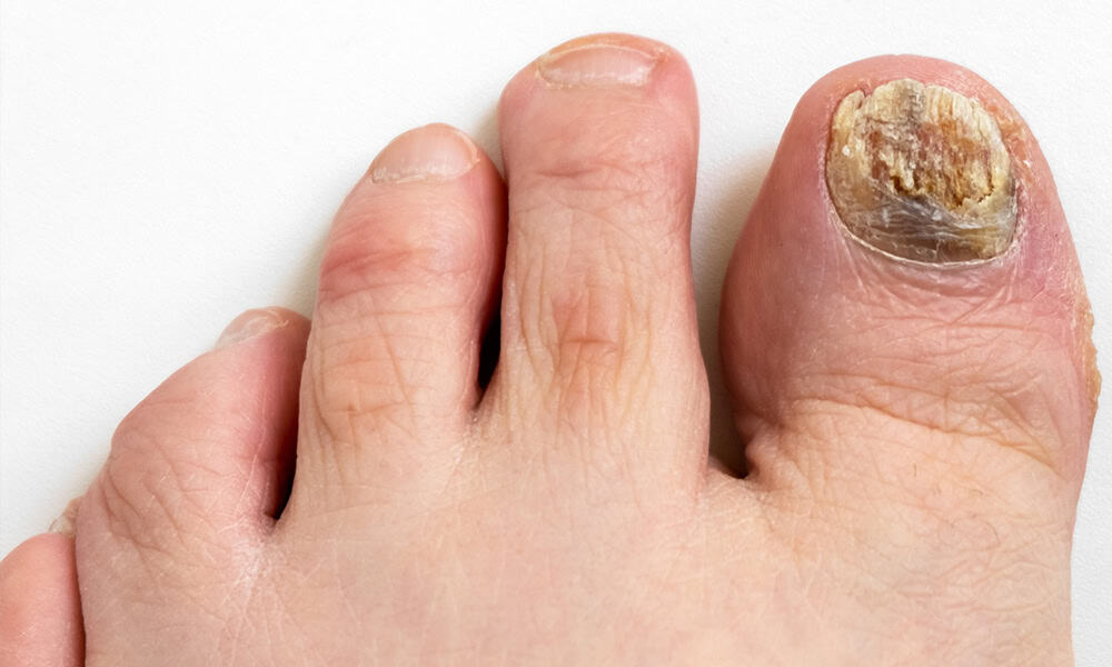 Fungal Nail Infection top view
