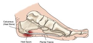 Heel Spur