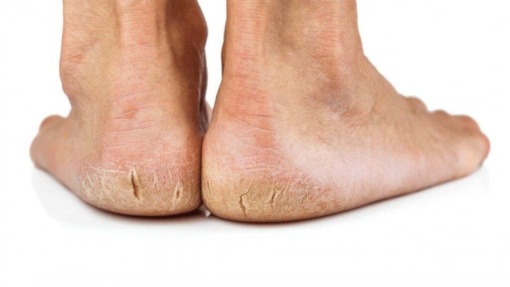 How to Fix Cracked Heels Permanently
