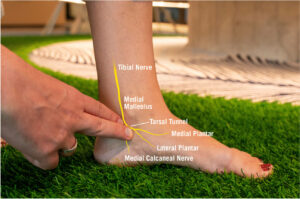Medial Calcaneal Nerve