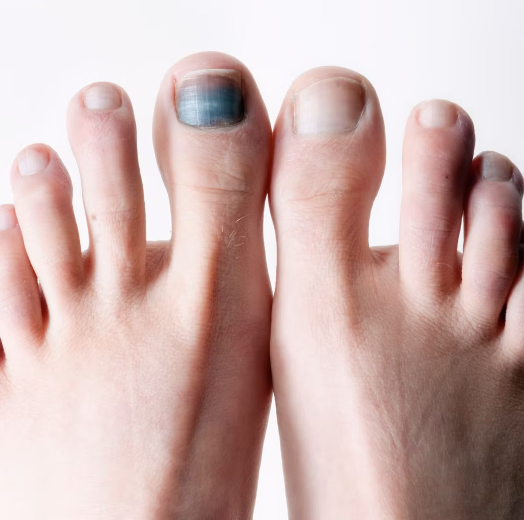 Toe Nails Blackening