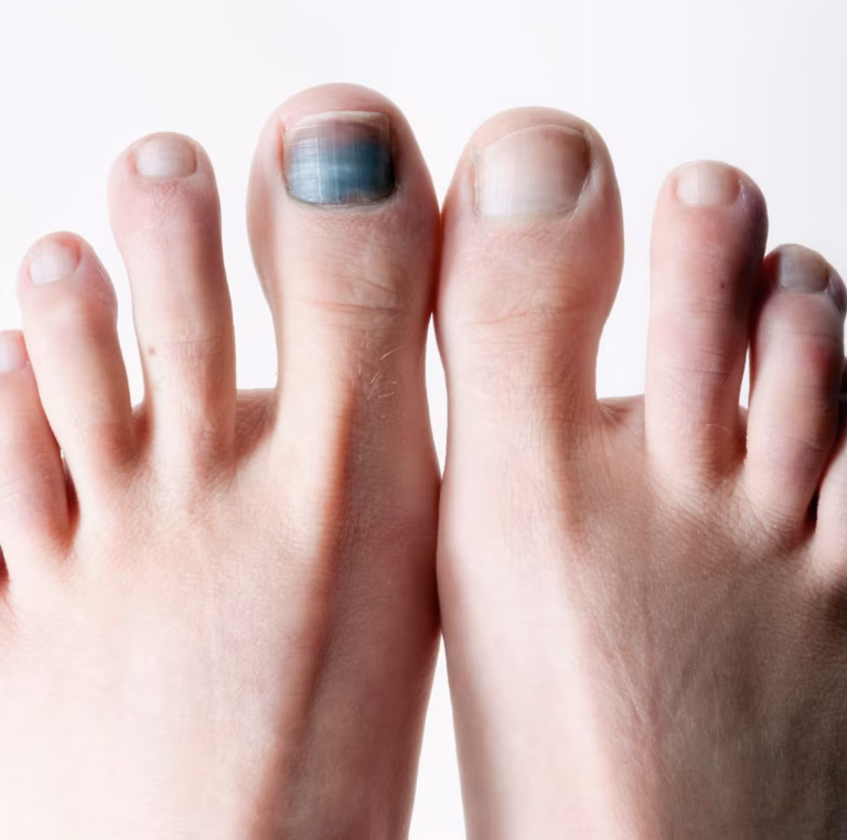 Toe Nails Blackening