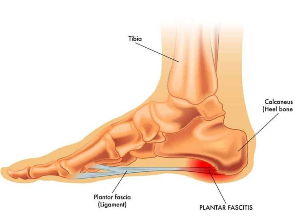 What us Plantar fasciitis