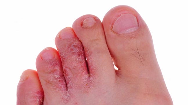 Close-up of scaling and redness between toes associated with athlete’s foot
