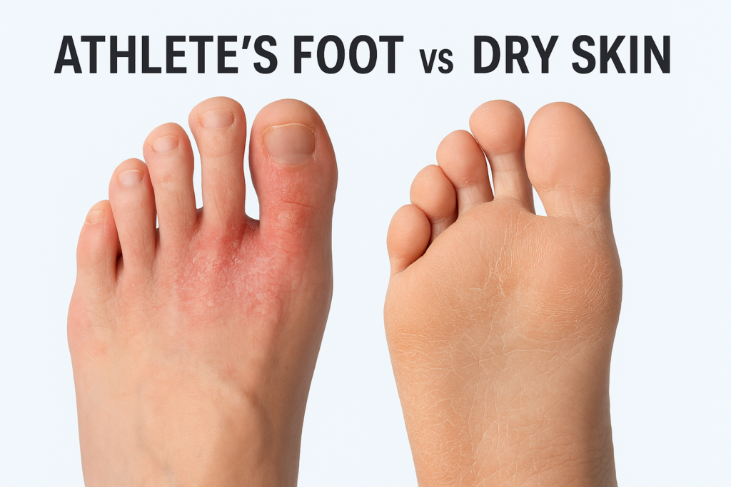 Athlete's Foot vs Dry Skin: How to Tell the Difference