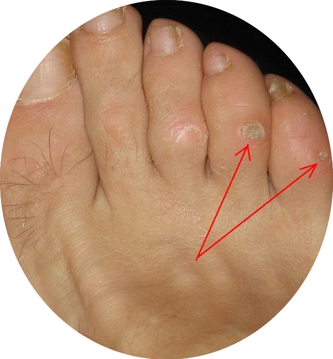 Hard corns on toes from repeated pressure, ModPod Podiatry Sydney