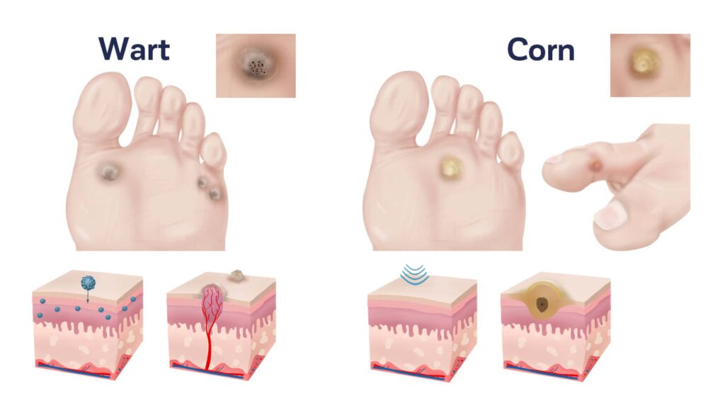 Medical illustration comparing a plantar wart and a corn on the foot