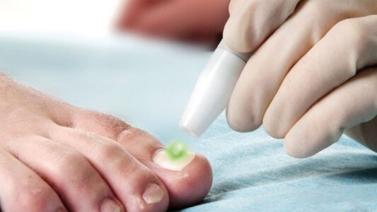 Hot laser for fungal nails